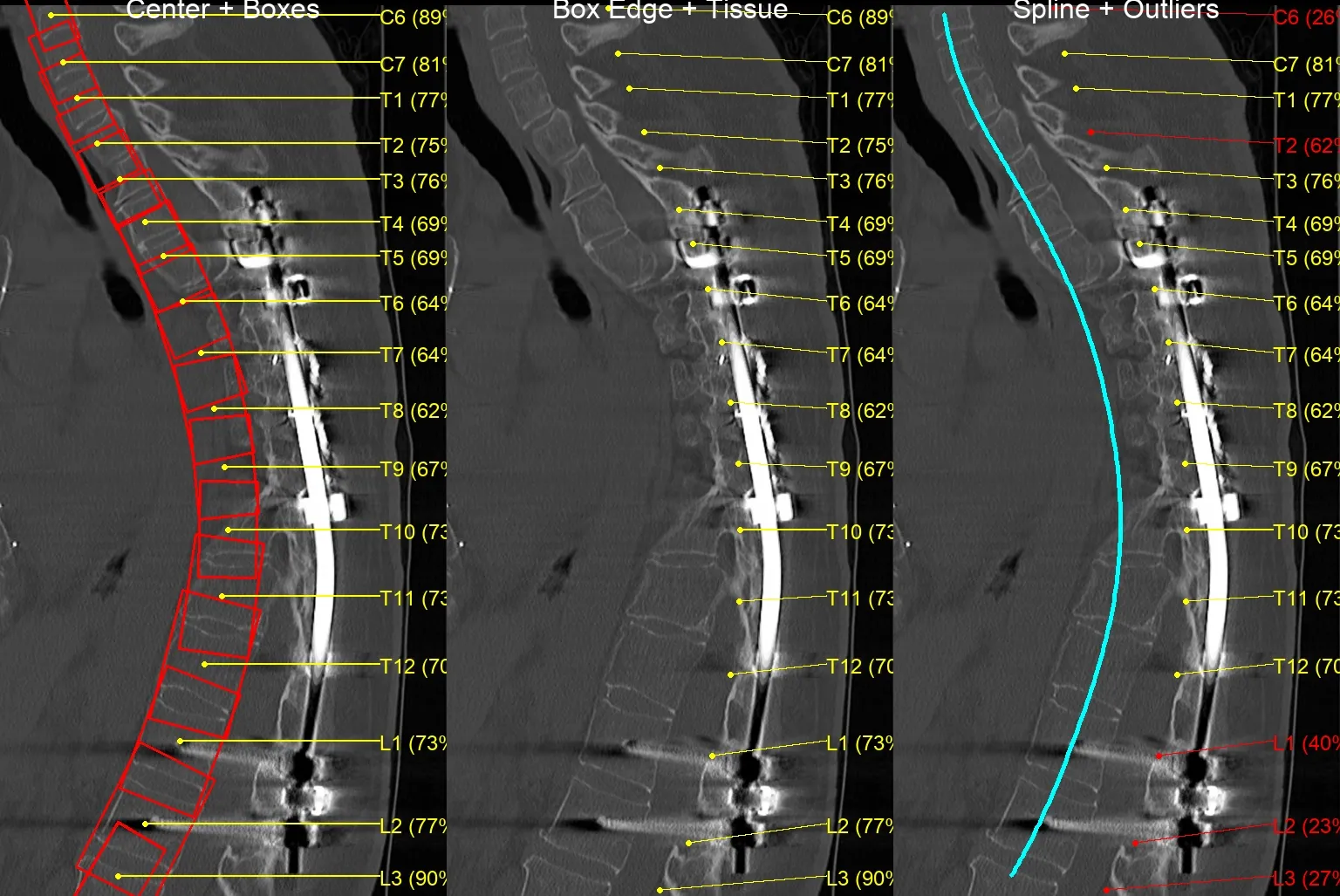 Sagittal CT of a post-operative instrumented spine with a fixation rod and metal-streak artifact; the pipeline still boxes, centers, and splines the vertebrae around the hardware.